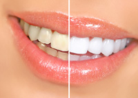 Teeth whitening in the Cordova, Collierville and Eastern Memphis, TN Area